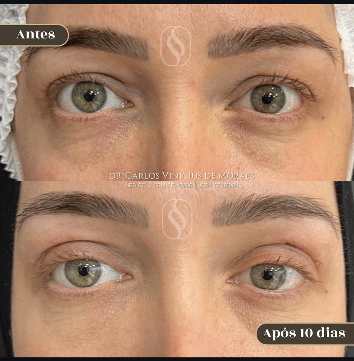 Antes e depois blefaroplastia