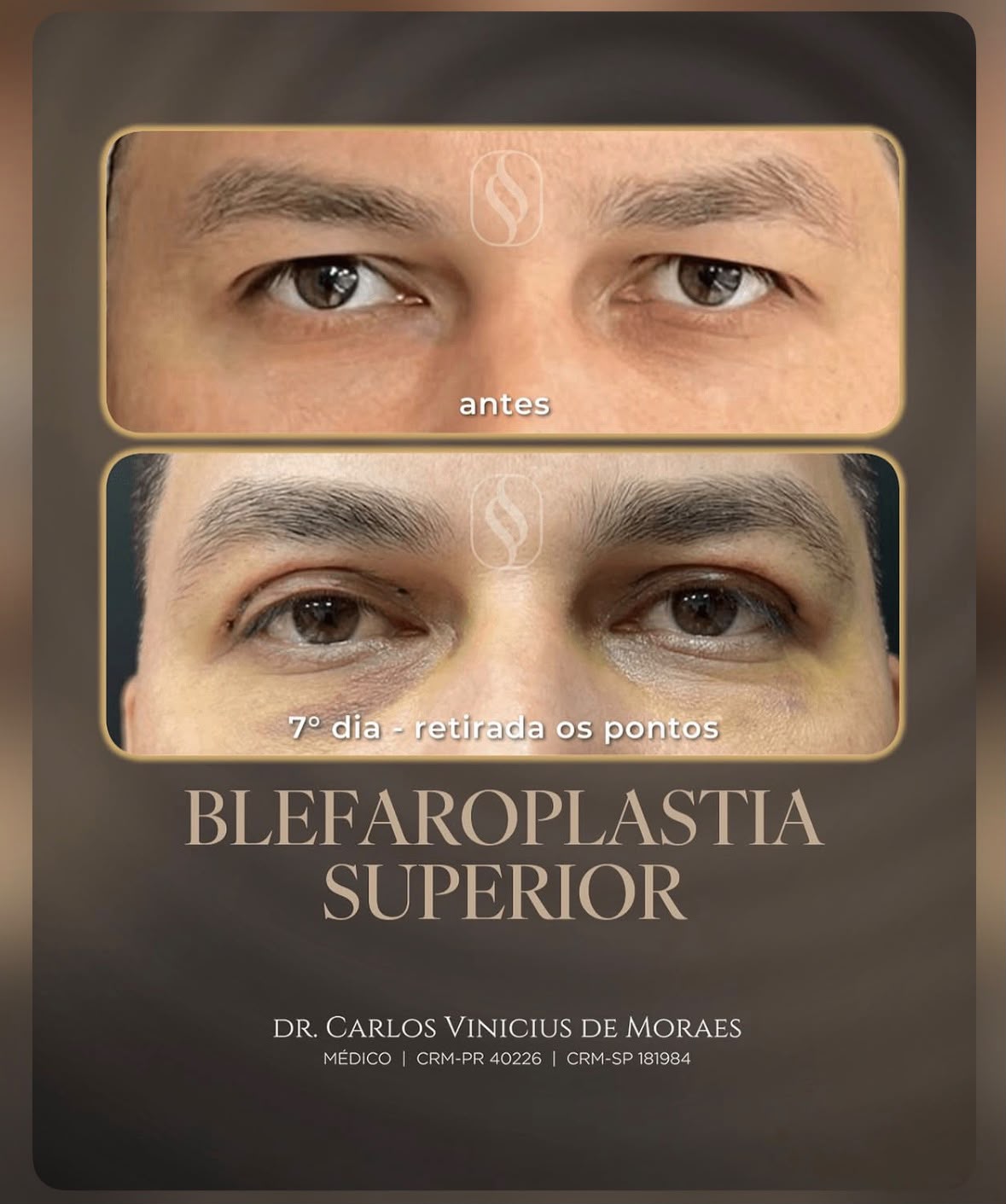 Resultado de blefaroplastia
