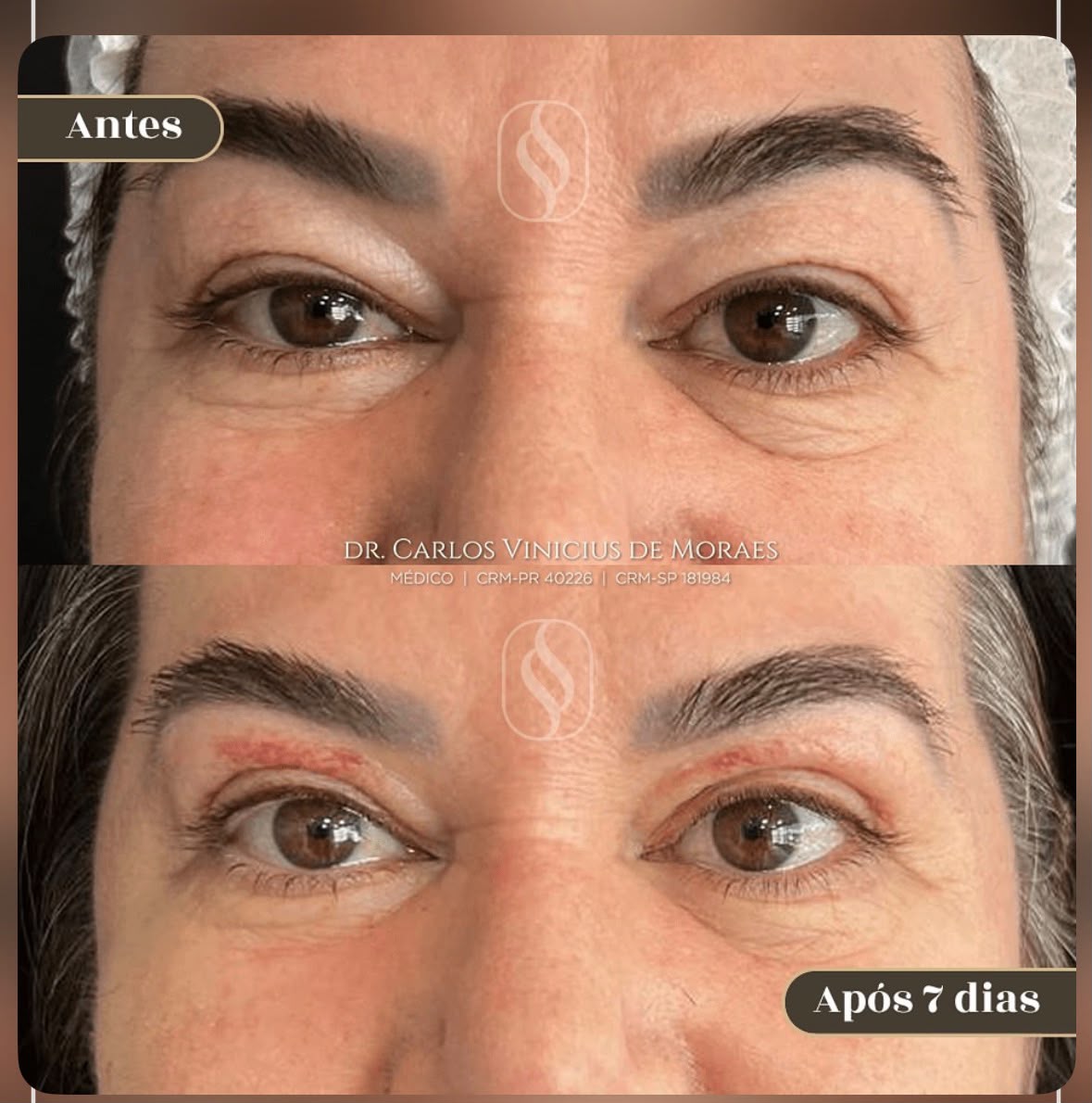 Detalhe do procedimento de blefaroplastia