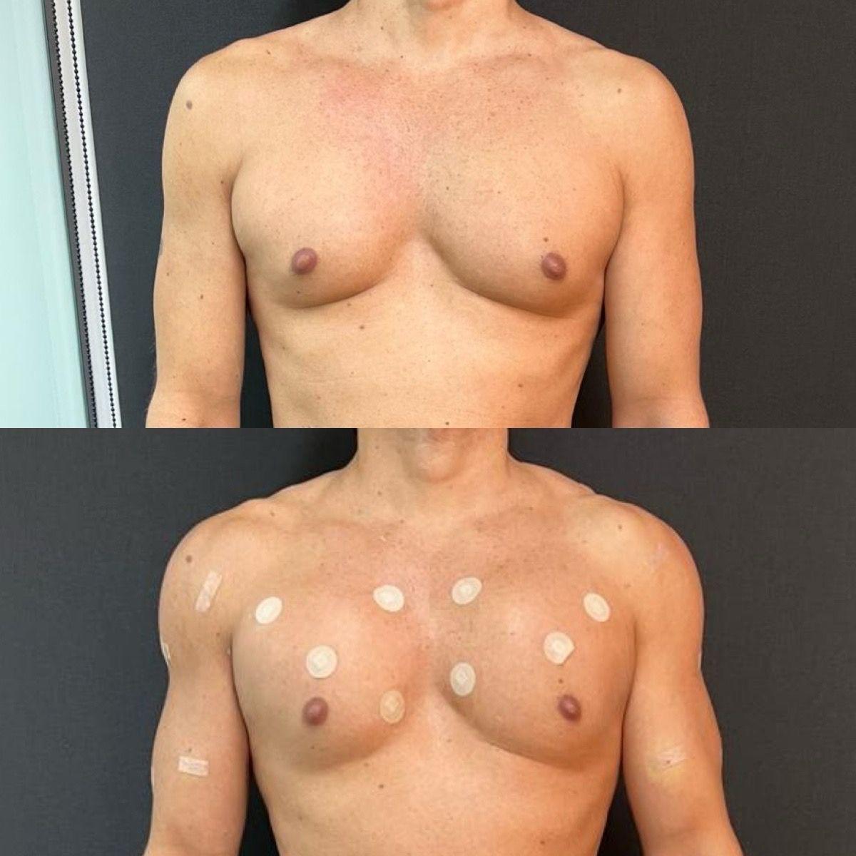 Preenchimento Corporal antes e depois