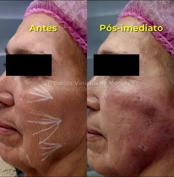 Endolaser Subdérmico antes e pós-imediato