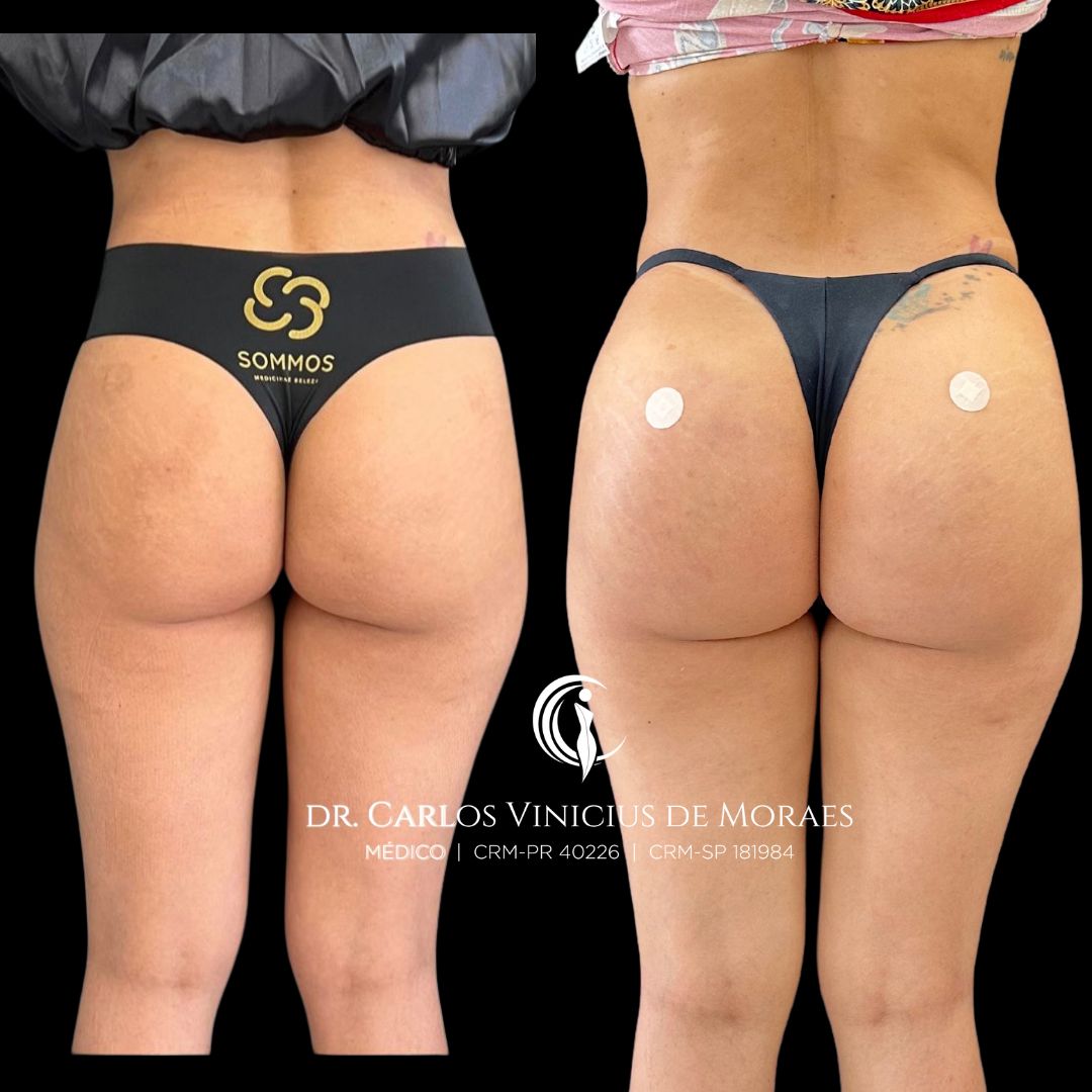Harmonização de Glúteos antes e depois