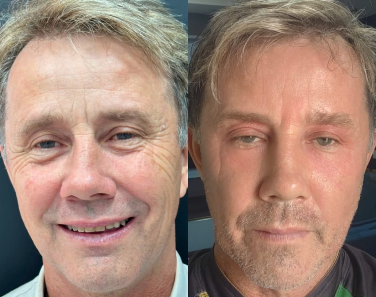 Laser CO2 Híbrido antes e depois