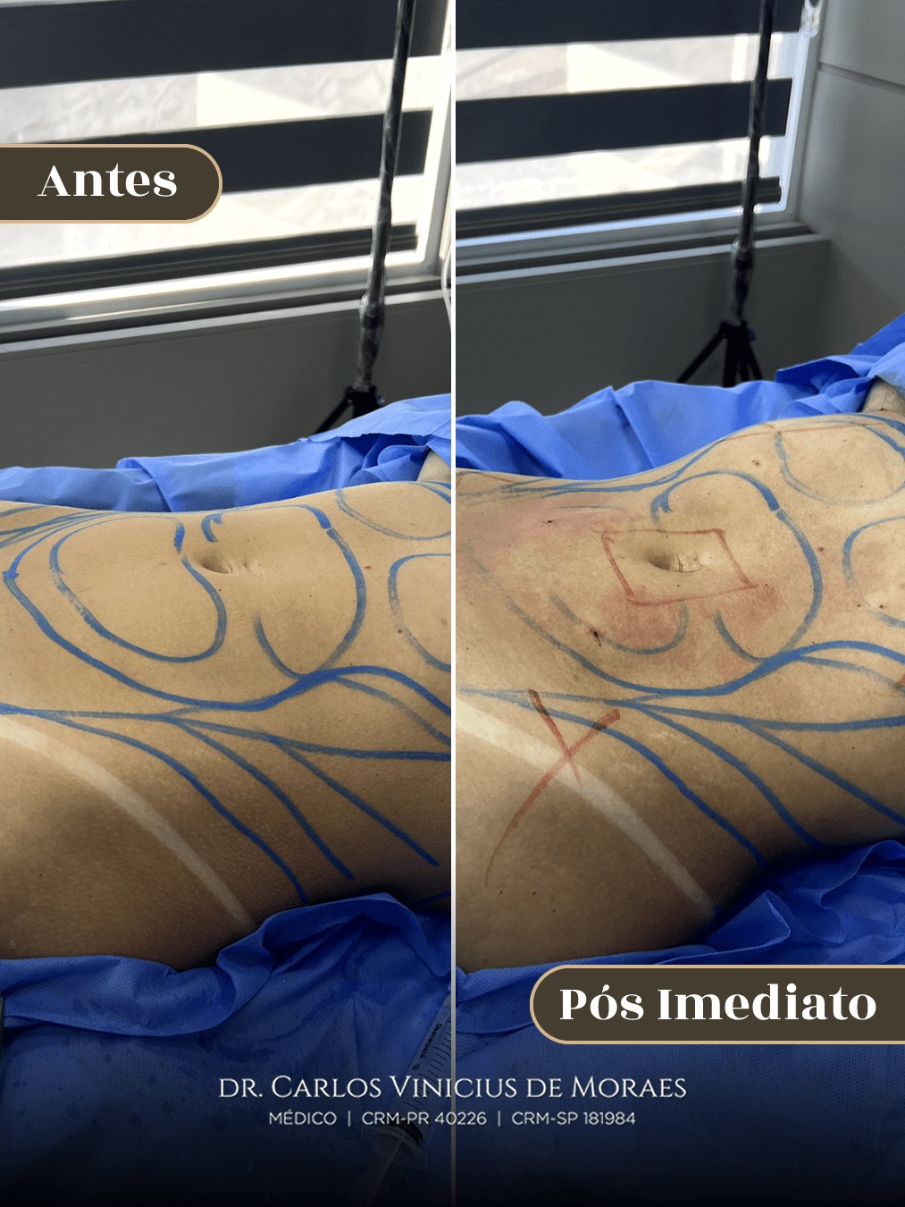 Mini Lipoaspiração antes e depois