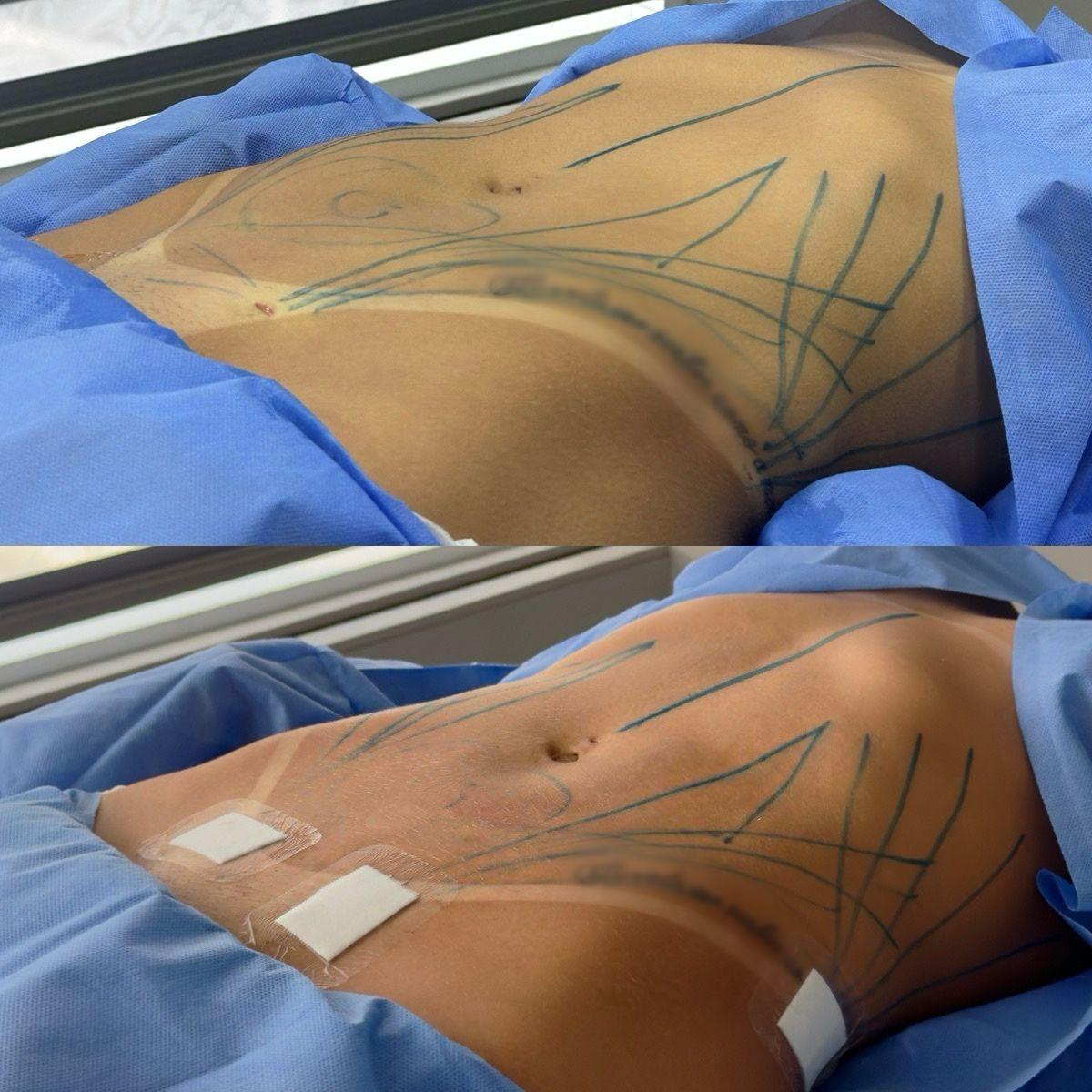 Resultado mini lipoaspiração